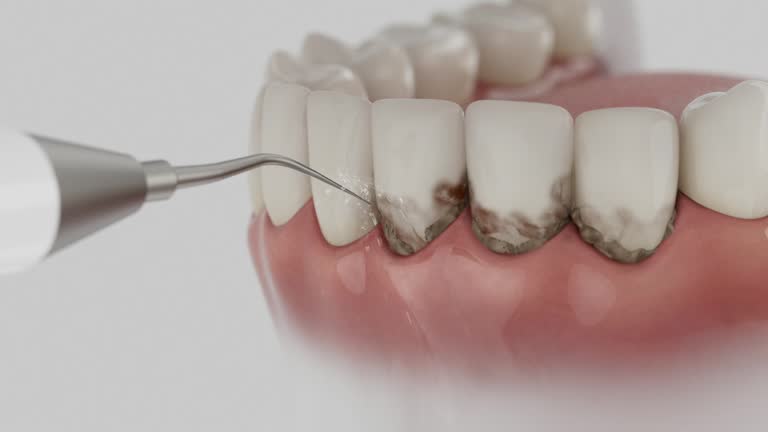 Trusted Wisdom Tooth Removal service in Cedarville, OH - Dentist Open Now
